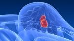 Գեր կանանց մոտ ավելի մեծ է կրծքագեղձի քաղցկեղի հավանականությունը